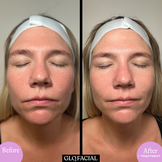 Glo2Facial